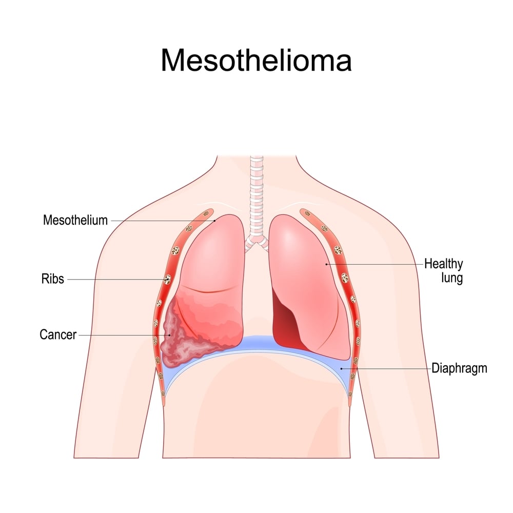 Patients with Mesothelioma See Positive Outcomes from Vinorelbine