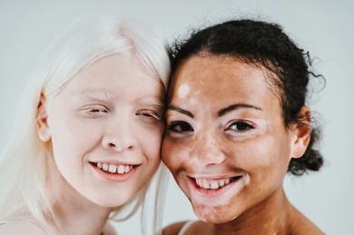 Nitisinone Breakthrough: Glimmer of Hope for Type 1B Oculocutaneous Albinism