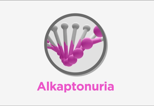 What is Alkaptonuria (AKU) and Its Treatment