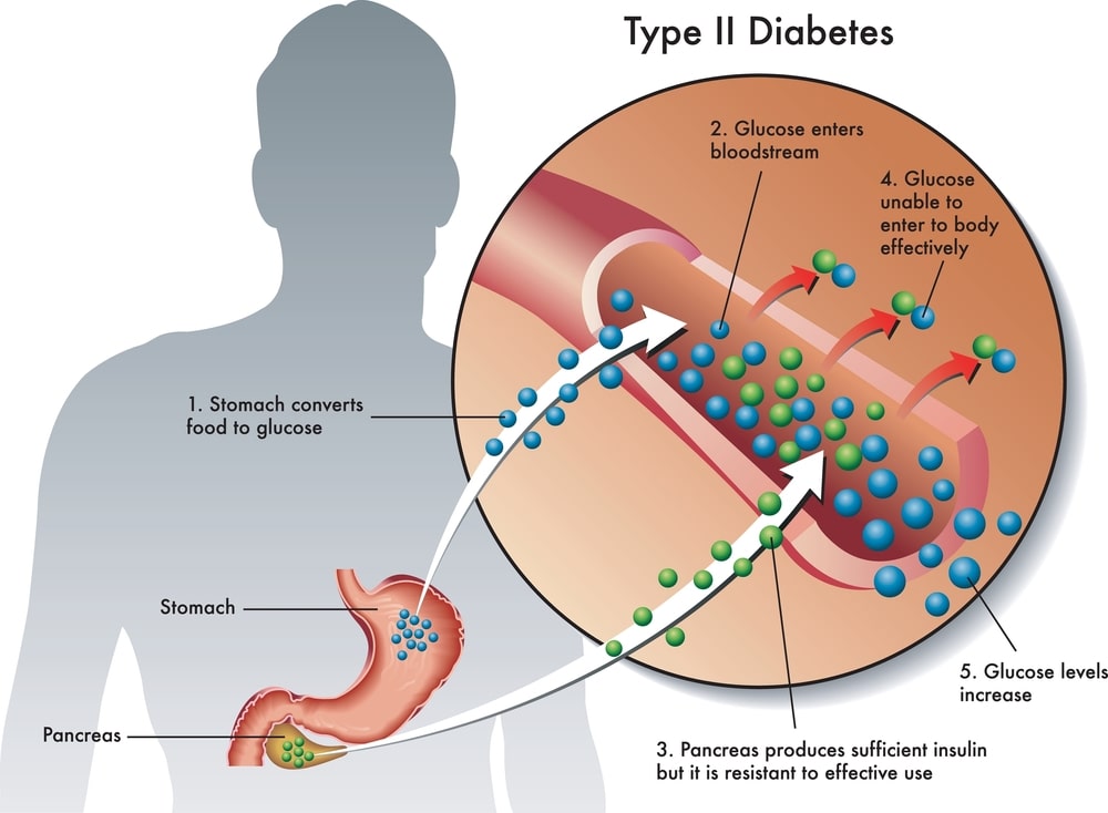 Type 2 Diabetes : Diagnosis and Treatment