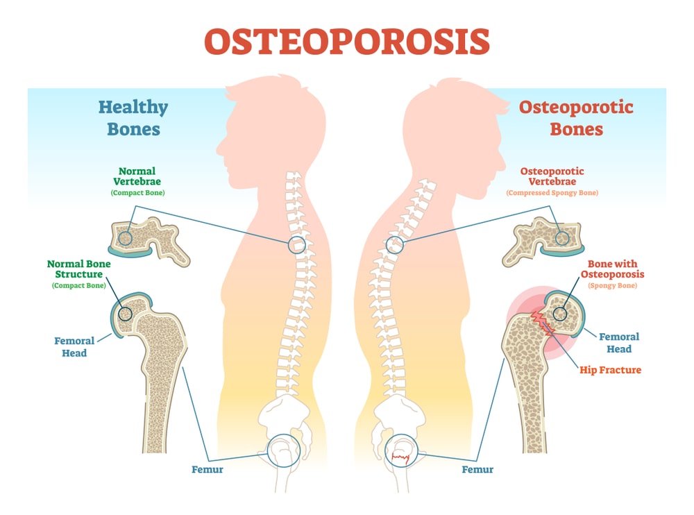 All About Osteoporosis: causes, symptoms, Risk factors, diagnosis, and treatment