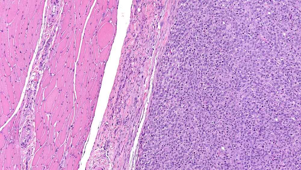 Rhabdomyosarcoma: Current Treatments, Challenges, and Future Strategies